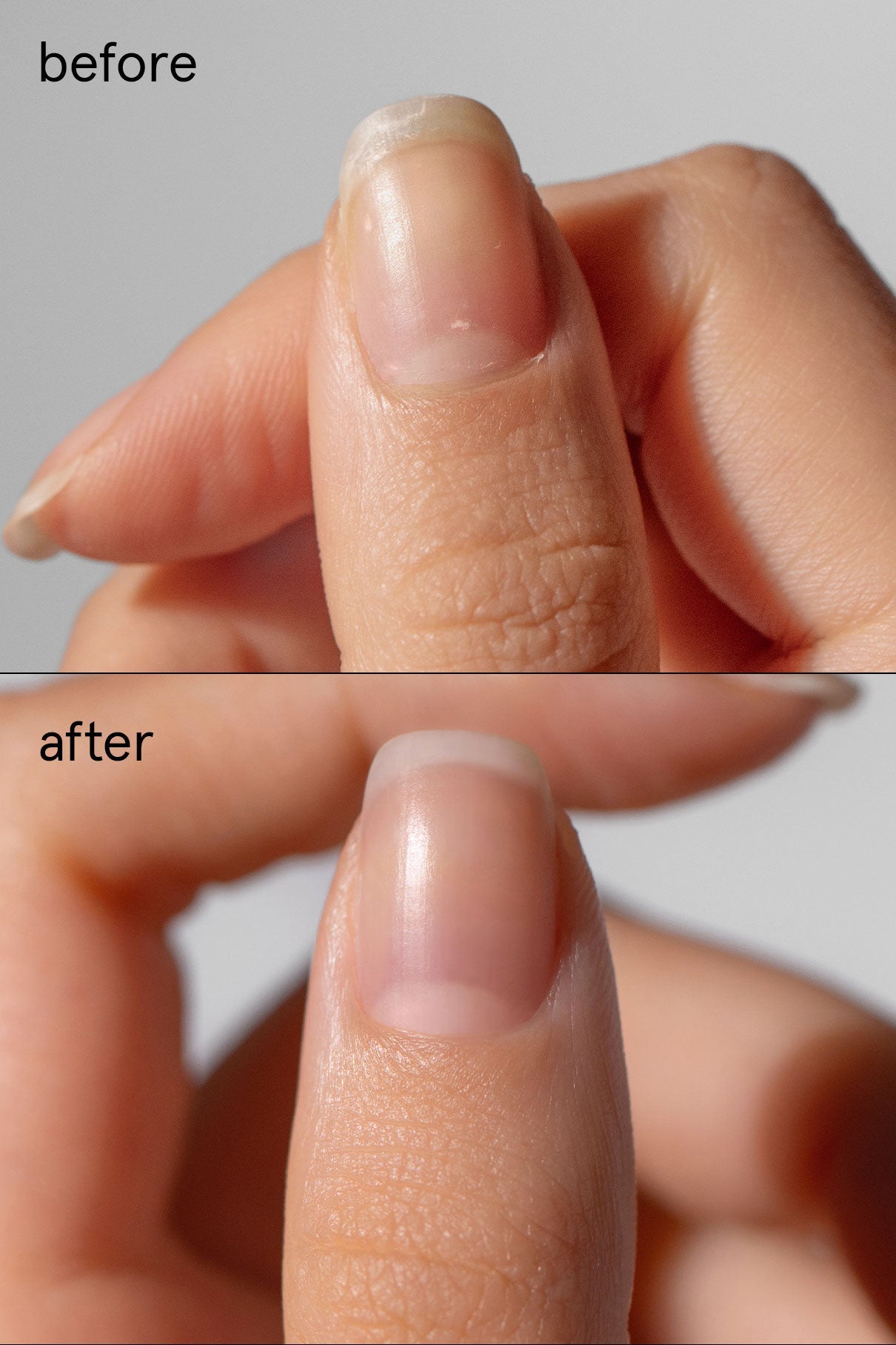 Nail Recovery Treatment