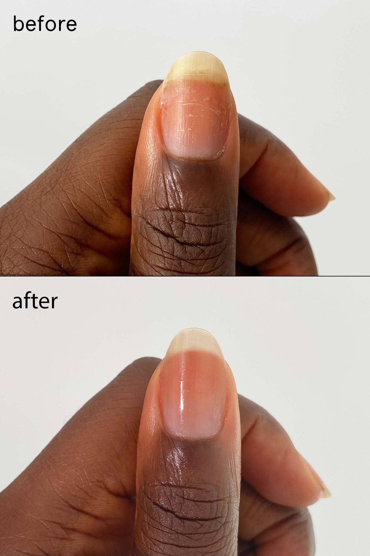Nail Recovery Treatment