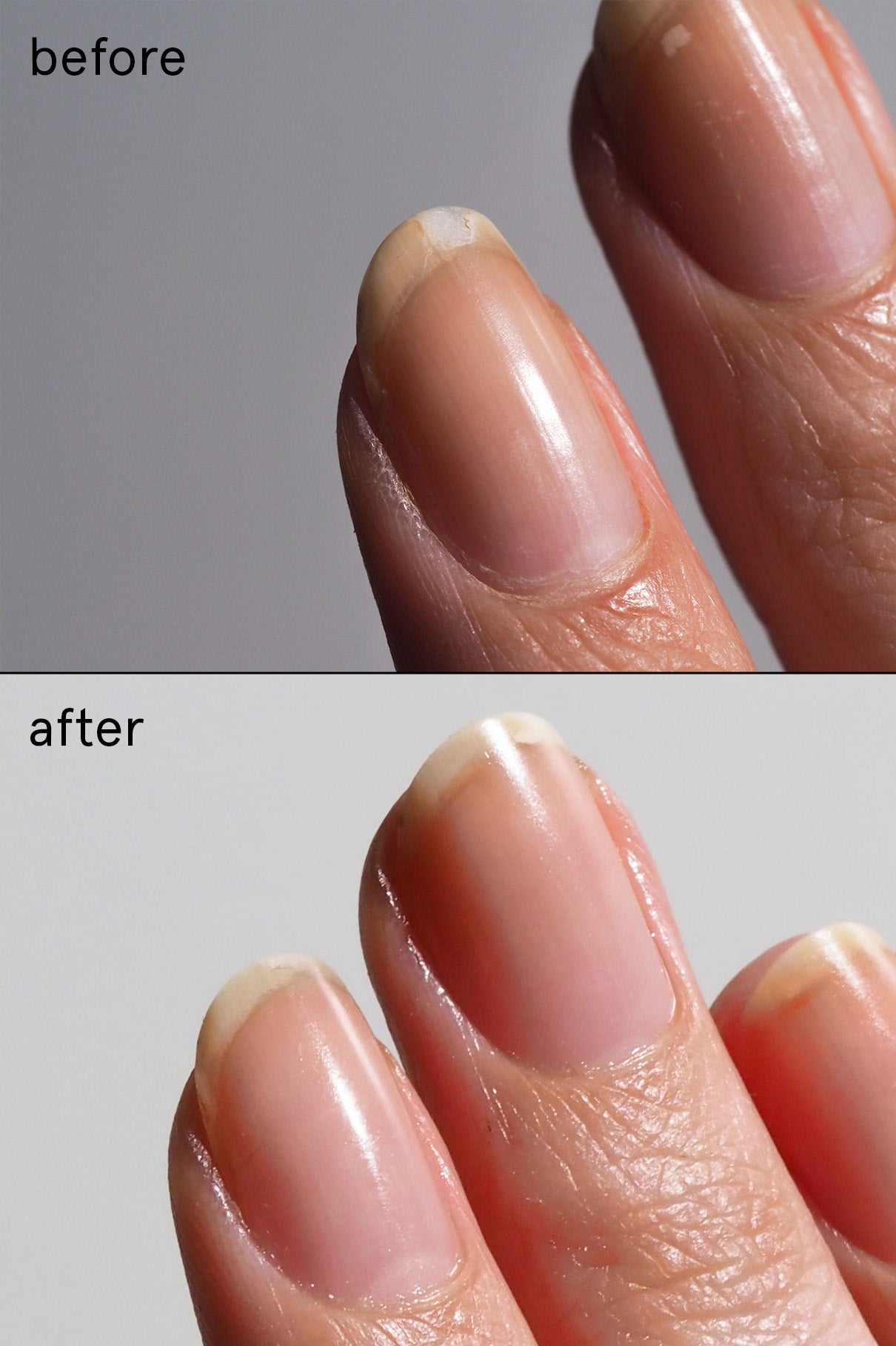 Nail Recovery Treatment