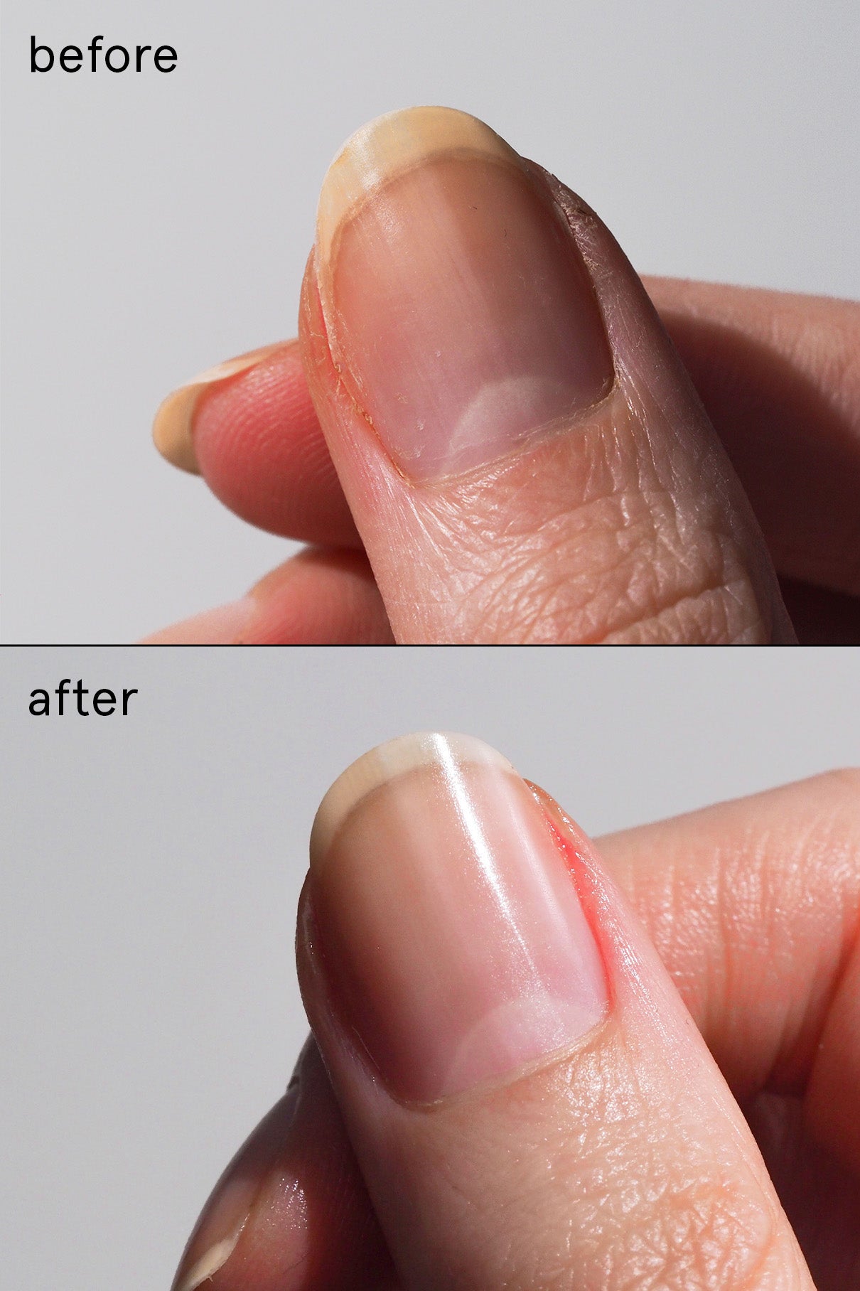 Nail Recovery Treatment